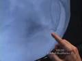 Uterine Fibroid Embolization