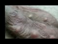 Laser Co2 sebaceous cysts of the scrotum