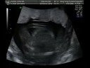 18th July Ultrasound (continued...)