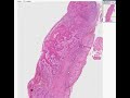 Histopathology Tongue-- Squamous cell carcinoma