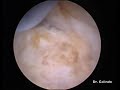 Instituto Madrileño de Traumatología.En este video se muestra el tratamiento del atrapamiento del tendón del subescapular entre la coracoides y el troquin. El tratamiento artroscópico del conocido como Síndrome Subcoracoideo es muy reciente, no mas de tres años. Las ventajas del tratamiento artroscópico sobre el abierto, son evidentes.Subcoracoid impingement, which is defined as narrowing of the space between the coracoid process and the humerus, is an uncommon and infrequently recognized cause of shoulder pain. It is an important entity to be aware of because it has been identified as a cause of persistent postoperative shoulder pain after rotator cuff repair. Clinically subcoracoid impingement is characterized by pain at the anterior aspect of the shoulder.This video describes the arthroscopic technique which has enormous advantages over the open surgery.