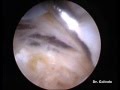 Artroscopia de hombro. Coracoplastia. Dr. E. Galindo Martens