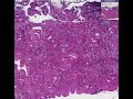 Histopathology Spleen--Sickle cell disease