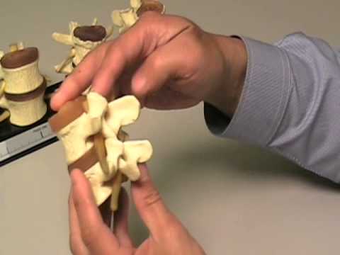 how to cure osteophytes