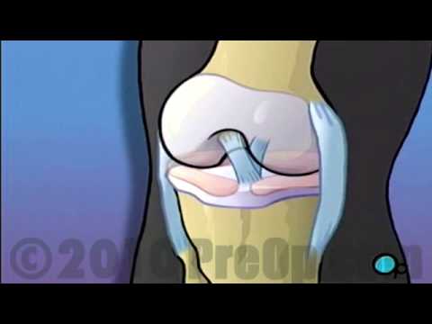 how to repair meniscus