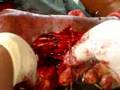Cut wound being treated by African doctors