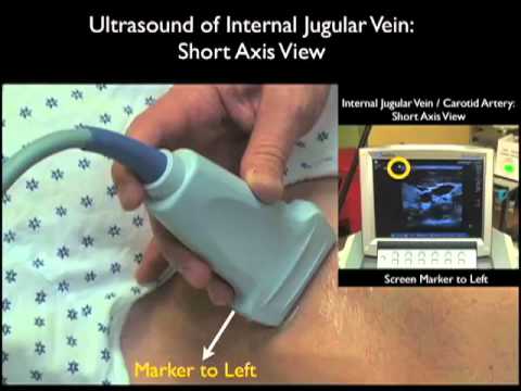 how to locate ijv