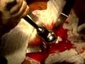 Podcast:Birmingham Hip Resurfacing Procedure From...