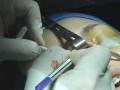 videos de Rhinoplasty In the Operating Room - Tip Cartilage Contouring