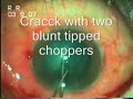 Phacoemulsification in Subluxated Hard Cataract.Dr Sudhalkar
