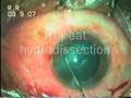 Phacoemulsification in Subluxated Hard Cataract