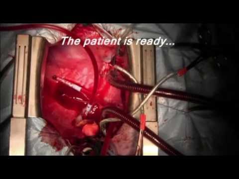 how to transplant a heart