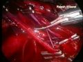 laparoscopic uretero-ureterostomy for tubercular upper ureteric strictures