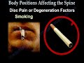 low back pain video .sacroiliac joint ,spine and discs are exposed to loads .This Educational animation video describing body positions which produce the highest measured pressure on the the discs of the lumbar spine. It has been determined that the highest intradiscal pressure is place on the discs when a person is in the seated position while leaning forward and holding weight. anatomy ,aligment andDegeneration factors are also described which may attribute to lumbar spine problems.patient with a spine problem ,disorder,disc herniation prolapse or bulge ,,xrays and MRI are usually obtained .massage adjustment rehab ,realigment and stretch to achieve flexbility of the spine vertebrae and muscles.brace injection for pain relief .doctors will perform surgery of decompression and or fusion if coservative treatment is not helpful for the patient.