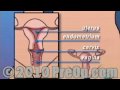 PreOp® Educación del Paciente Dentro de la vagina Dilatación y curetaje D & C Cirugía