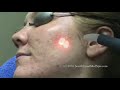 Laser Acne Treatment Laser Acne Treatment