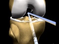 Click to View : ACL Reconstruction - Patients Education