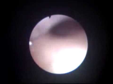 how to perform awake fiberoptic intubation