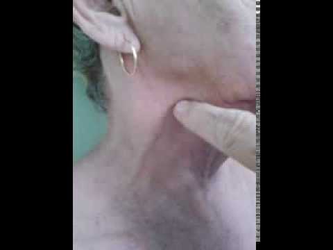 how to treat svc syndrome