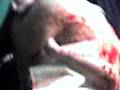 Parto abruptio placentae-Final stage labor vaginal,abruptio Placentae