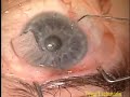 Trabeculectomy Mitomycin C Right Eye