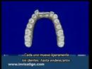 Invisdent60