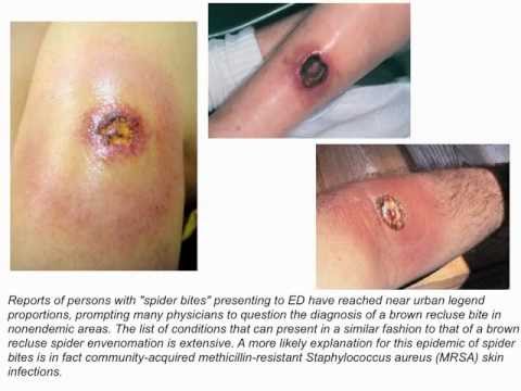 how to treat spider bites