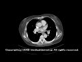 Chest CT, mediastinal and bilateral hilar lymphadenopathy