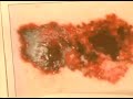 How to Identify Skin Cancer Signs : Signs of Melanoma Carcinoma Skin Cancer How to Identify Skin Cancer Signs : Signs of Melanoma Carcinoma Skin Cancer