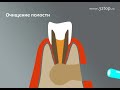 Хирургическое лечение кисты зуба