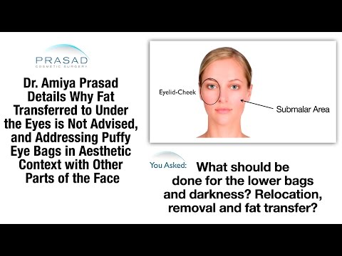 The Best Treatment for Eye Bags, and Why Fat Transfer Under Eyes is Not Advised