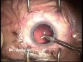 WHITE CATARACT PHACO WHITE CATARACT PHACO