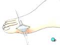 videos de Malpractice Medical Bunion Removal Foot Surgery 3