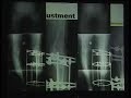 Lecture - HTO in Knee Osteoarthritis - Part 3