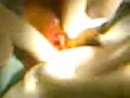 Abscesso Submentoniano