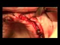 bonesplitting-boneaugmentation-with-dental-implants-part-2.html