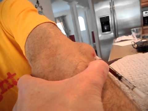 how to drain olecranon bursitis