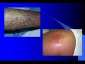 Methicillin-resistant Staphylococcus aureus (MRSA, often pronounced 