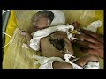 Indian Baby born with her heart on her Chest Indian Baby born with her heart on her Chest