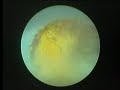 PCNL with Vibrolith PLUS video 1