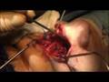 The Superior Rhinotomy