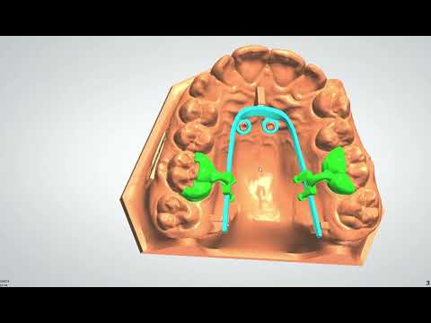 Molar Distalization Appliance