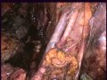 Lymphadenectomy After Radical Cystectomy - A New Access
