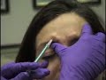Botox