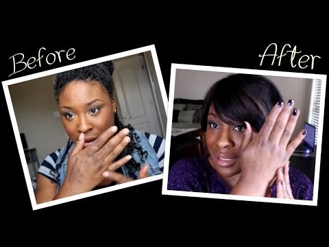how to treat scars from a burn