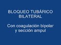 Dr. JERONIMO AMADO M. BTB con coagulación bipolar y sección.