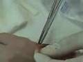 Removing The Pins
