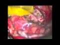 Brain AVM Surgery, Malformación Arteriovenosa Cerebral (Thrace-Greece)