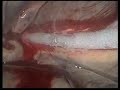 CryoMaze: A Surgical Treatment For Lone Atrial Fibrillation  Heart Diseases Seniors' Health