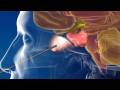 Endoscopic Endonasal Approach — Minimally Invasive Brain Surgery